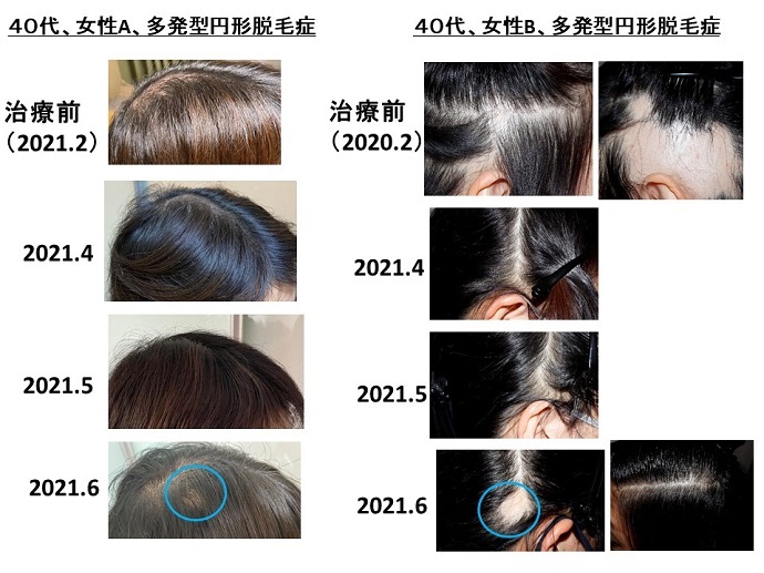 全頭脱毛　病院